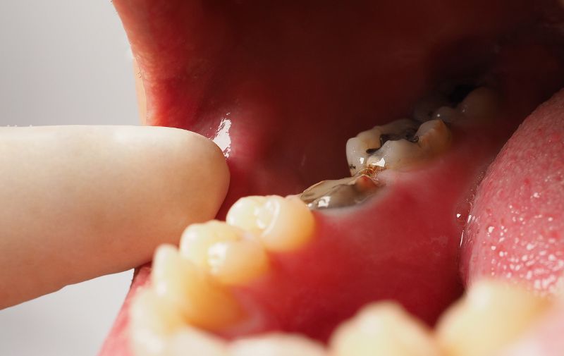 What are the 4 Causes of Tooth Decay