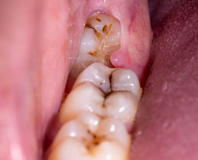 Wisdom teeth and dental health