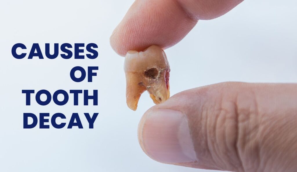 What are the 4 Causes of Tooth Decay